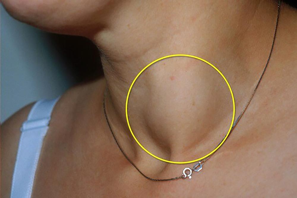 prmer-rak_na_ščitnici